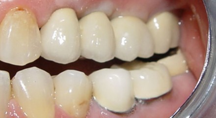 implants after cementation in mouth